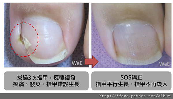 凍甲處理、凍甲矯正、矯正後復發 、發膿、肉芽處理(凍甲/嵌甲 凍甲處理、凍甲矯正、矯正後復發 、發膿、肉芽處理(凍甲/嵌甲