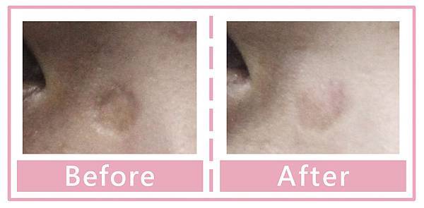 水痘疤 真皮移植 水痘疤 真皮移植