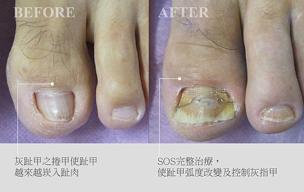 萎縮性灰指甲 萎縮性灰指甲