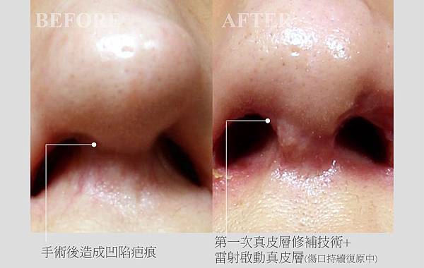鼻柱攣縮疤痕 治療 鼻柱攣縮疤痕 治療