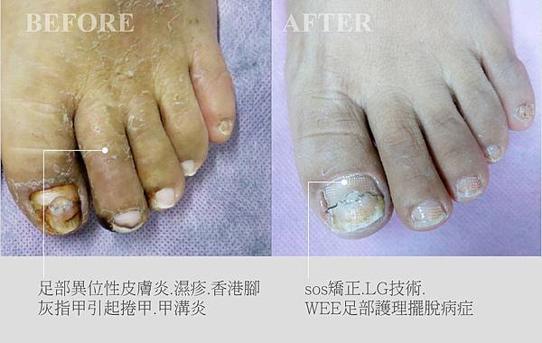 灰指甲治療 灰指甲治療