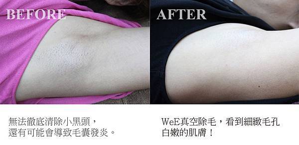 案例除毛林雅琪.jpg 案例除毛林雅琪.jpg