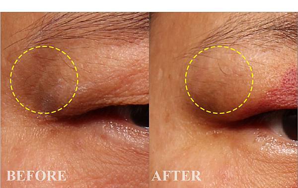 疤痕填補 疤痕填補