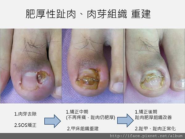 指甲長肉芽 甲溝炎治療過程