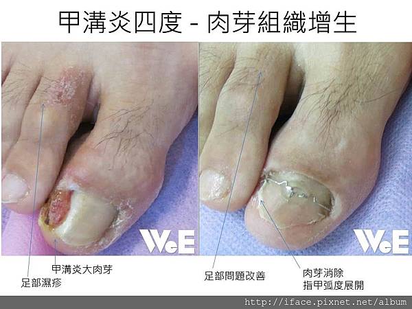 指甲長肉芽 指甲長肉芽