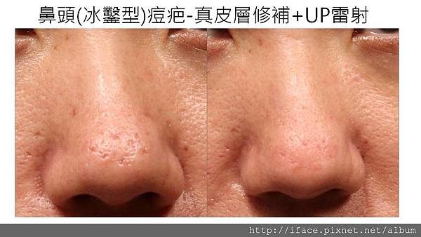 真皮移植 真皮移植