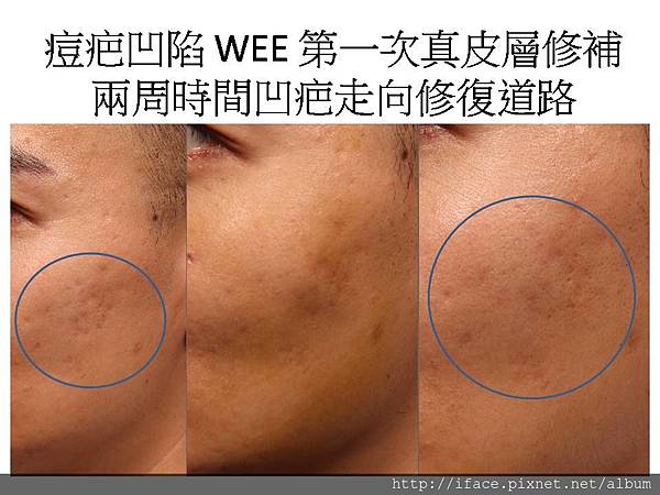 真皮移植 台北 滾動型痘疤治療