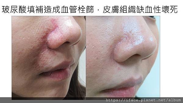 黃金期搶救玻尿酸注射/血管栓塞/缺血性壞死/組織壞死,從急性 黃金期搶救玻尿酸注射/血管栓塞/缺血性壞死/組織壞死,從急性