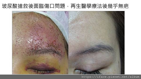 黃金期搶救玻尿酸注射/血管栓塞/缺血性壞死/組織壞死,從急性 黃金期搶救玻尿酸注射/血管栓塞/缺血性壞死/組織壞死,從急性