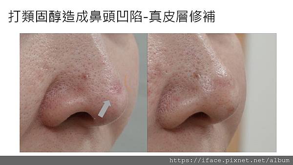 鼻頭痘疤 填補 鼻頭痘疤 填補