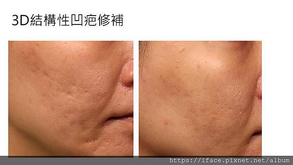 真皮層移植 真皮層移植