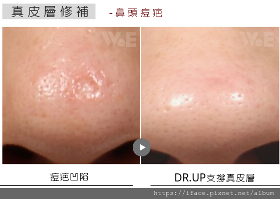 痘疤 真皮移植 痘疤 真皮移植