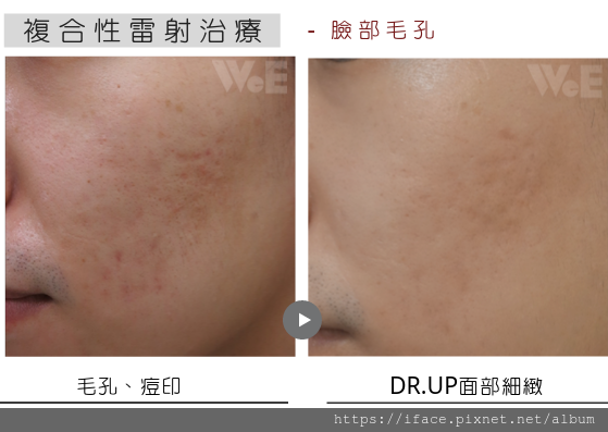 痘疤 up雷射 痘疤 up雷射