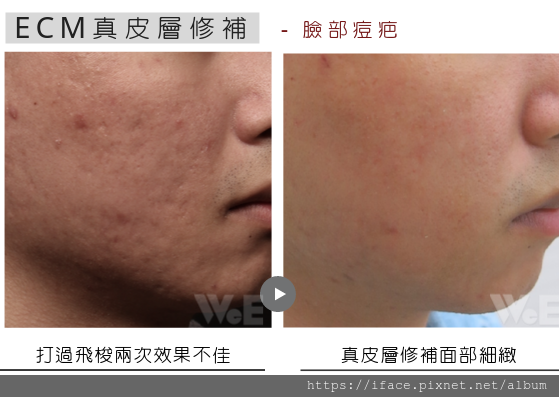 痘疤 真皮移植 痘疤 真皮移植