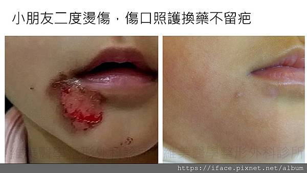 小朋友燙傷二三度