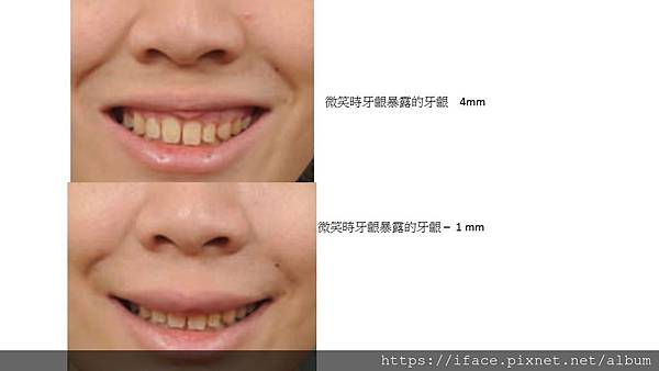 微笑時,牙齦外露 0.1mm 與 4mm 的差距 微笑時,牙齦外露 0.1mm 與 4mm 的差距