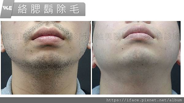 絡腮鬍除毛 絡腮鬍除毛