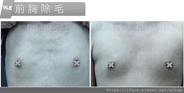 新竹 台中 真空除毛 推薦基尼線除毛 Vio私密除毛ko亞歷山大雷射除毛無痛快速除毛 永久乾淨白皙 維美整形美容外科與骨關節脊椎修復 台北新竹台中高雄