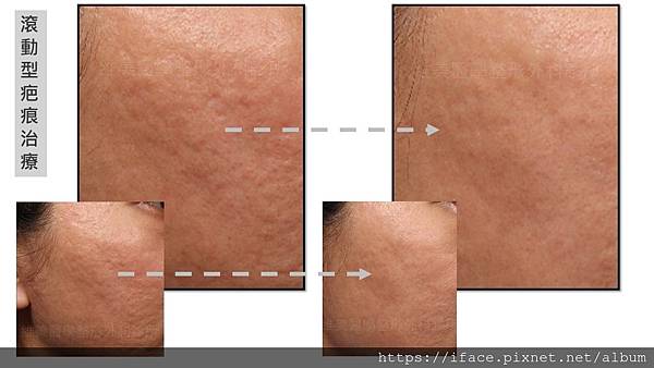 痘疤治療 痘疤治療
