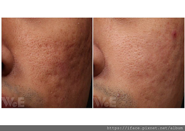 真皮層移植 真皮層移植