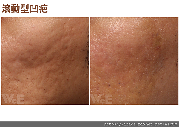 滾動型 滾動型痘疤治療