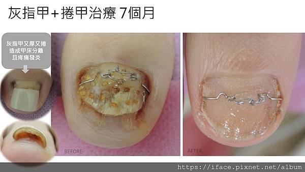 灰指甲捲甲 灰指甲捲甲