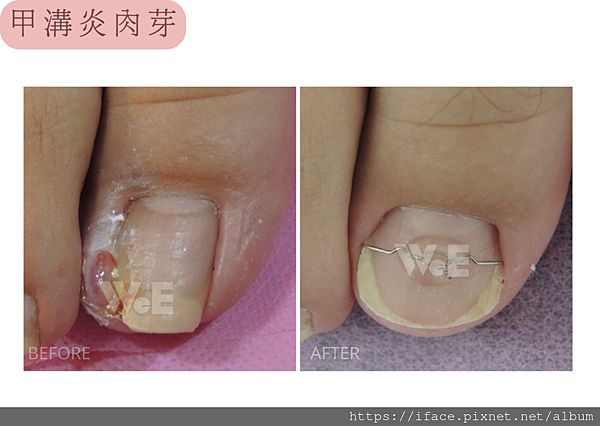 甲溝炎灰趾甲捲甲 甲溝炎灰趾甲捲甲