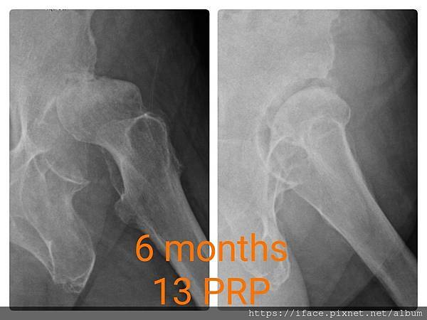 PRP注射膝關節