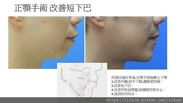 正顎手術改善短下巴側面照