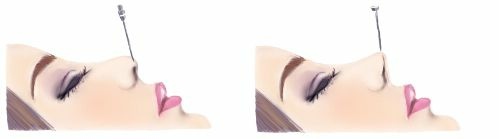 鼻埋線-鼻柱 鼻埋線-鼻柱