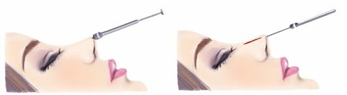 鼻埋線-山根 鼻埋線-山根