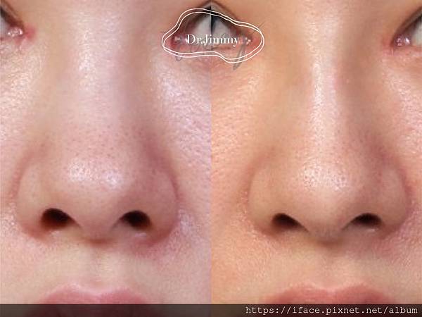 美型鼻雕 美型鼻雕