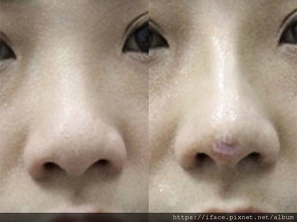 鼻埋線 玻尿酸 鼻埋線 玻尿酸