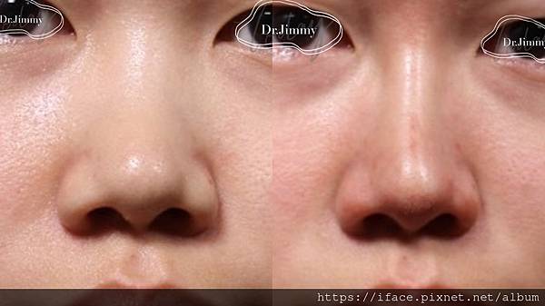 鼻埋線山根鼻鼻柱 鼻埋線山根鼻鼻柱