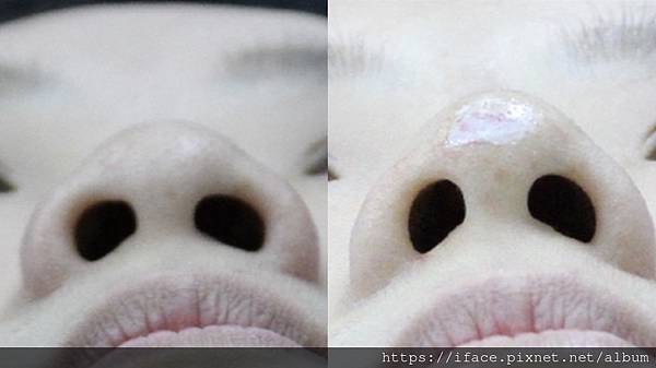 鼻埋線鼻柱 鼻埋線鼻柱