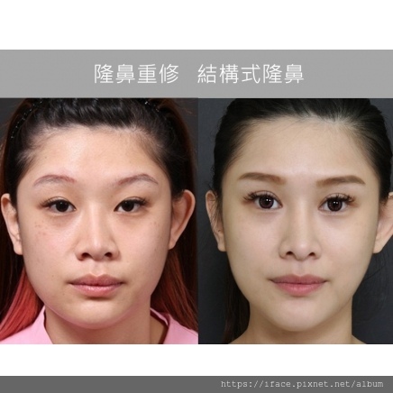 隆鼻案例 隆鼻案例