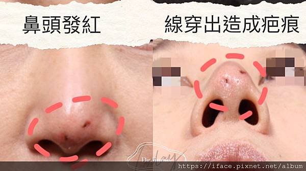 鼻埋線穿出 鼻埋線穿出