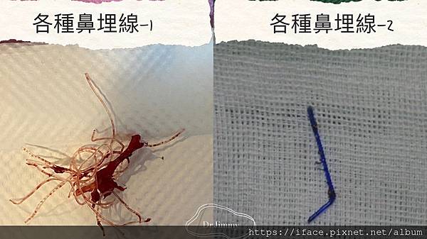 各種鼻埋線 各種鼻埋線