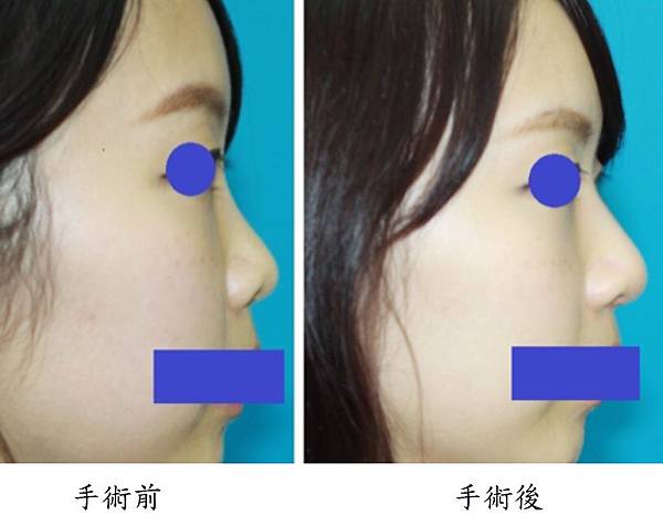 Rhinoplasty1