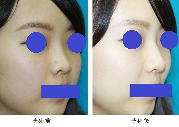 Rhinoplasty 2 Rhinoplasty 2