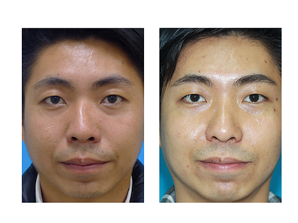 deviated nose deviated nose