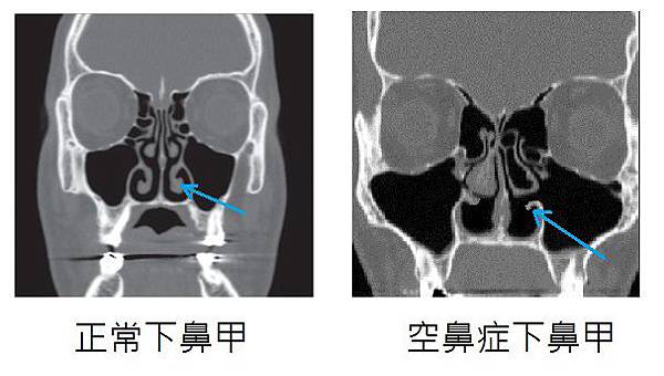 nose CT