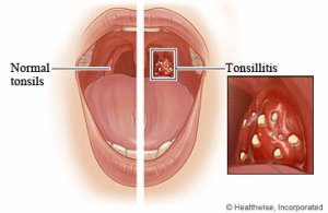 Tonsillolith