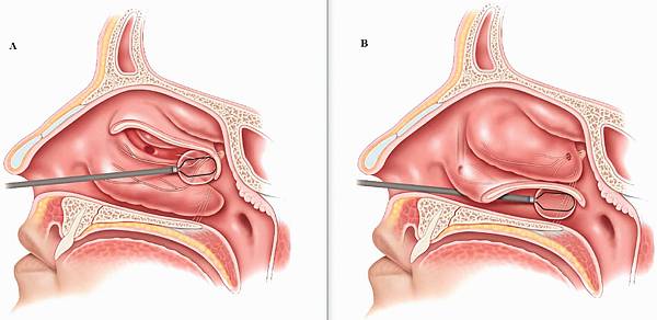 鼻過敏有救了!! 後鼻神經阻斷術(posterior nas