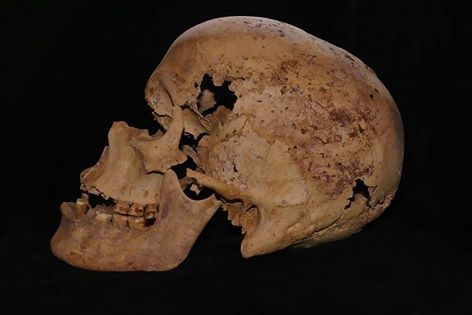 埃及乳癌 埃及乳癌