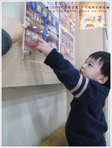 第二次塗氟 第二次塗氟