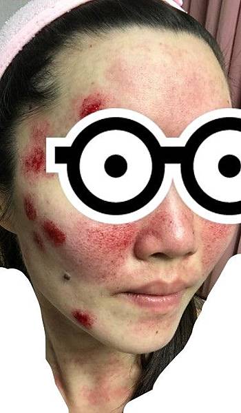 術後右臉.jpg 術後右臉.jpg