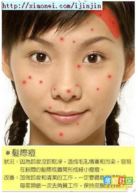 髮際痘 髮際痘