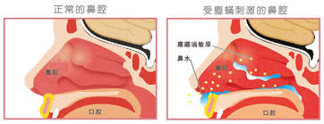 過敏性鼻炎