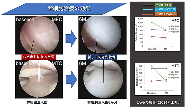 幹細胞治療再生軟骨